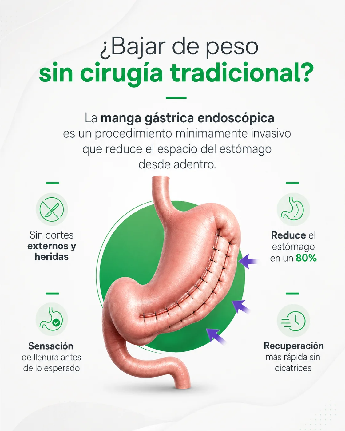 Gastroplastia endoscópica - manga gástrica sin cirugía